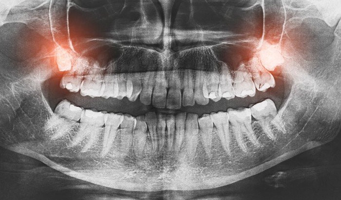 When Can Wisdom Teeth Grow After Age 30