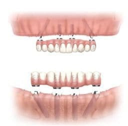 Teeth in a Day: Is it Possible? The answer is Yes!