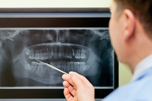 Dental Implant Bone Grafts