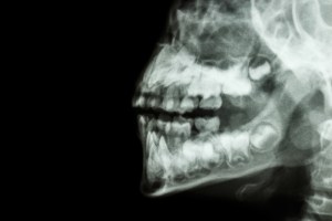 TMJ Surgery