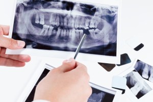 Bone Grafting 101