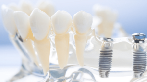 5 Facts About Dental Implants