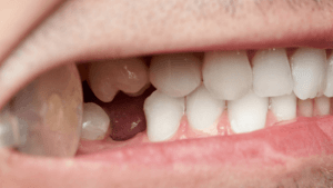 What To Do When Your Tooth Got Knocked Out