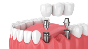 3 Options for Replacing Missing Teeth