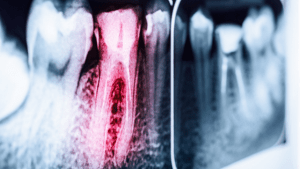 What You Need to Know About Root Canals
