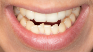 What Causes Malocclusion