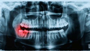 What You Need to Know About Impacted Wisdom Teeth