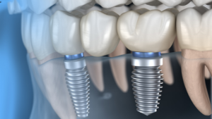 How Can I Tell if Dental Implants Are Right for Me?
