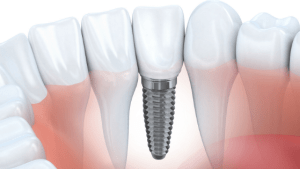Implants Vs. Dentures