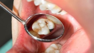 How Tooth Decay Can Cause Other Health Problems