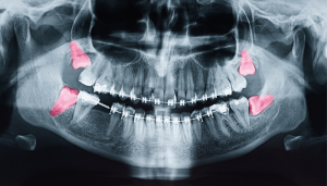 Uploaded ToIs it Safe to Remove All Four Wisdom Teeth at Once?