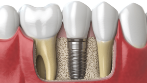 How Painful is a Dental Implant?