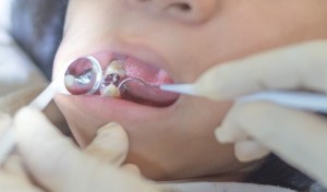 Dental Fillings: How Long Do Tooth Fillings Last?