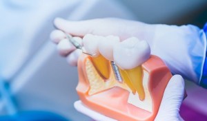 Are You Sedated When Putting in Dental Implants?