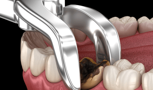 How Many Teeth Can be Extracted at Once