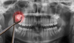 Is Wisdom Teeth Removal Dangerous?